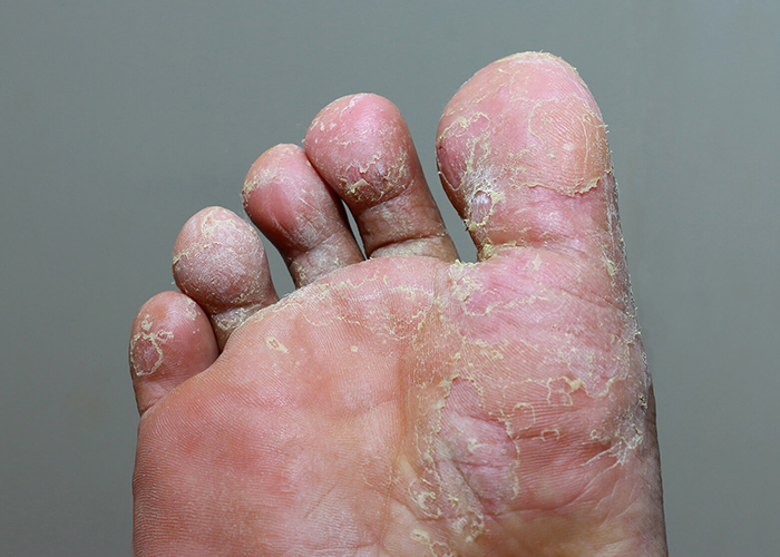 tinea pedis