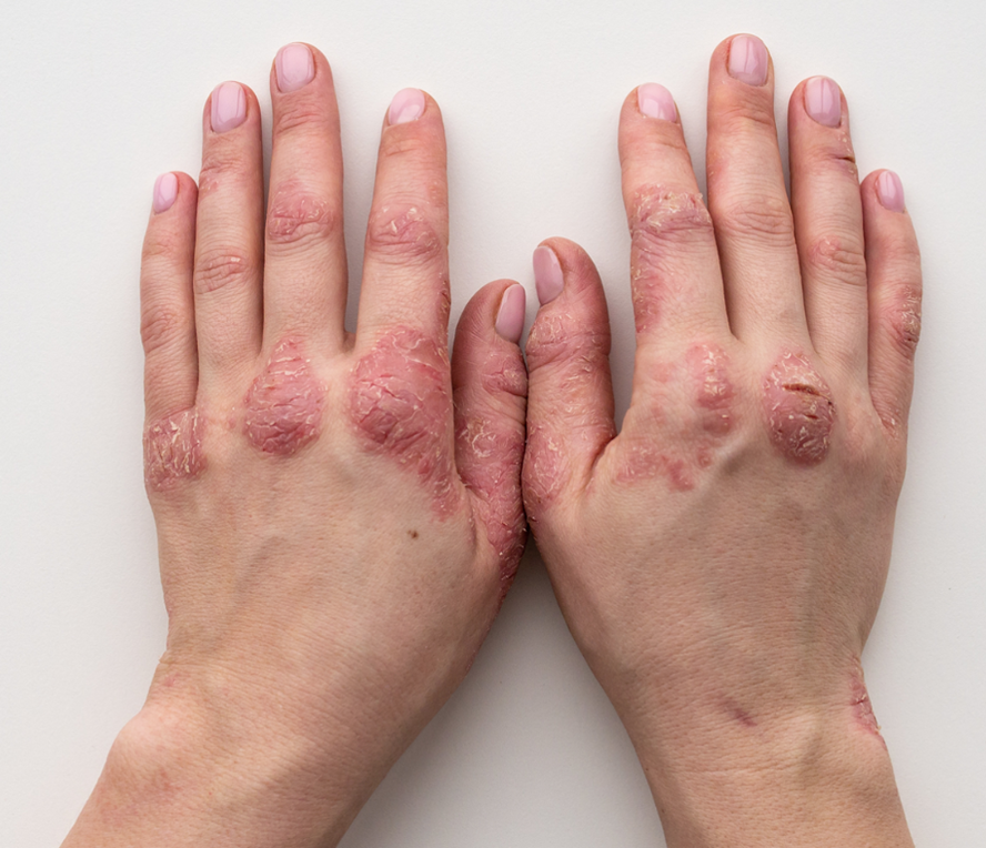 psoriasis